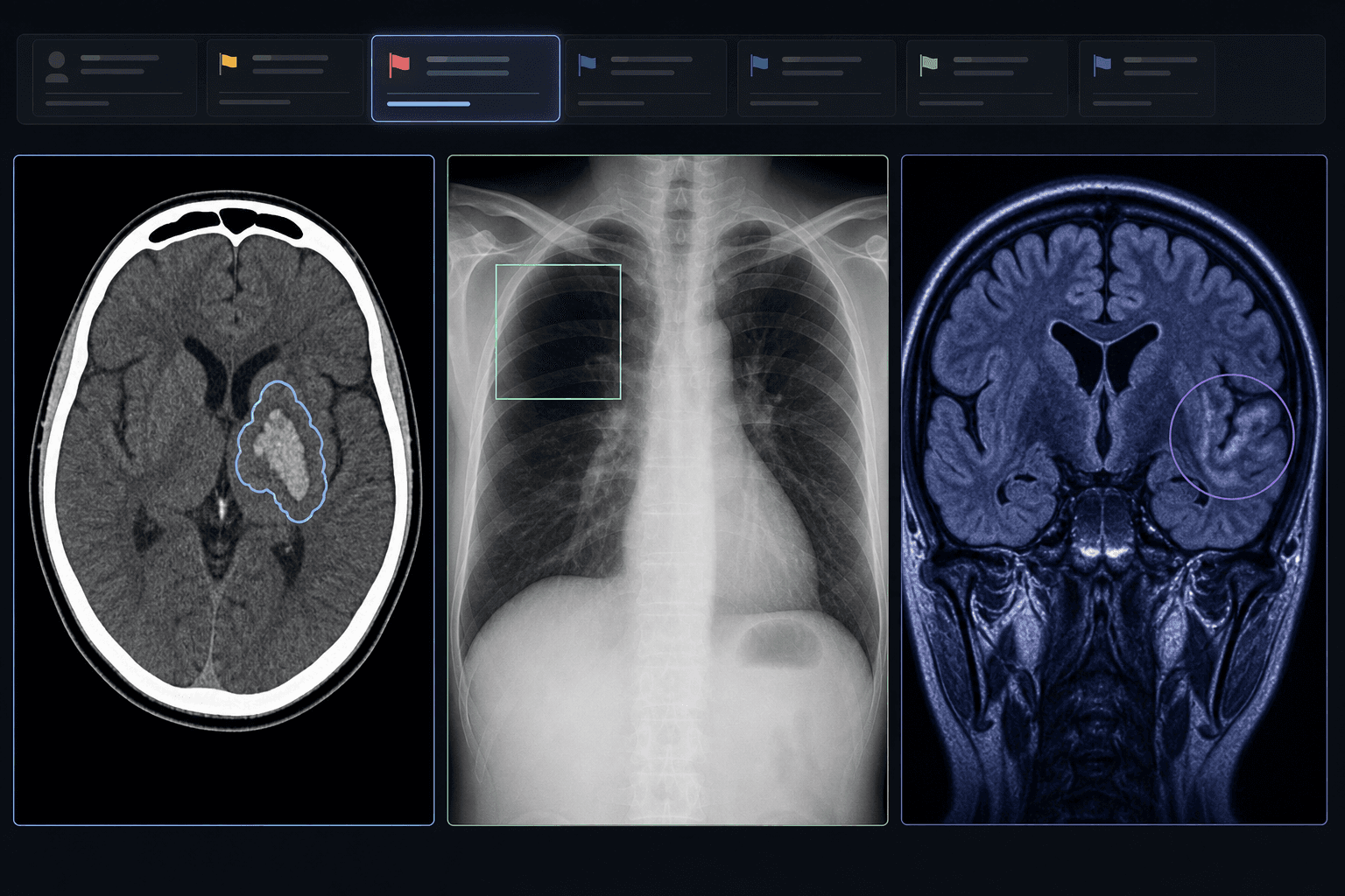 A medical editorial triptych showing three radiology imaging panels: a head CT with AI hemorrhage contour, a chest X-ray with AI pneumothorax bounding box, and a brain MRI with stroke territory detection marker, with a faint worklist prioritization interface strip above