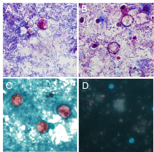 Cyclospora cayetanensis oocysts in stool under modified acid-fast stain