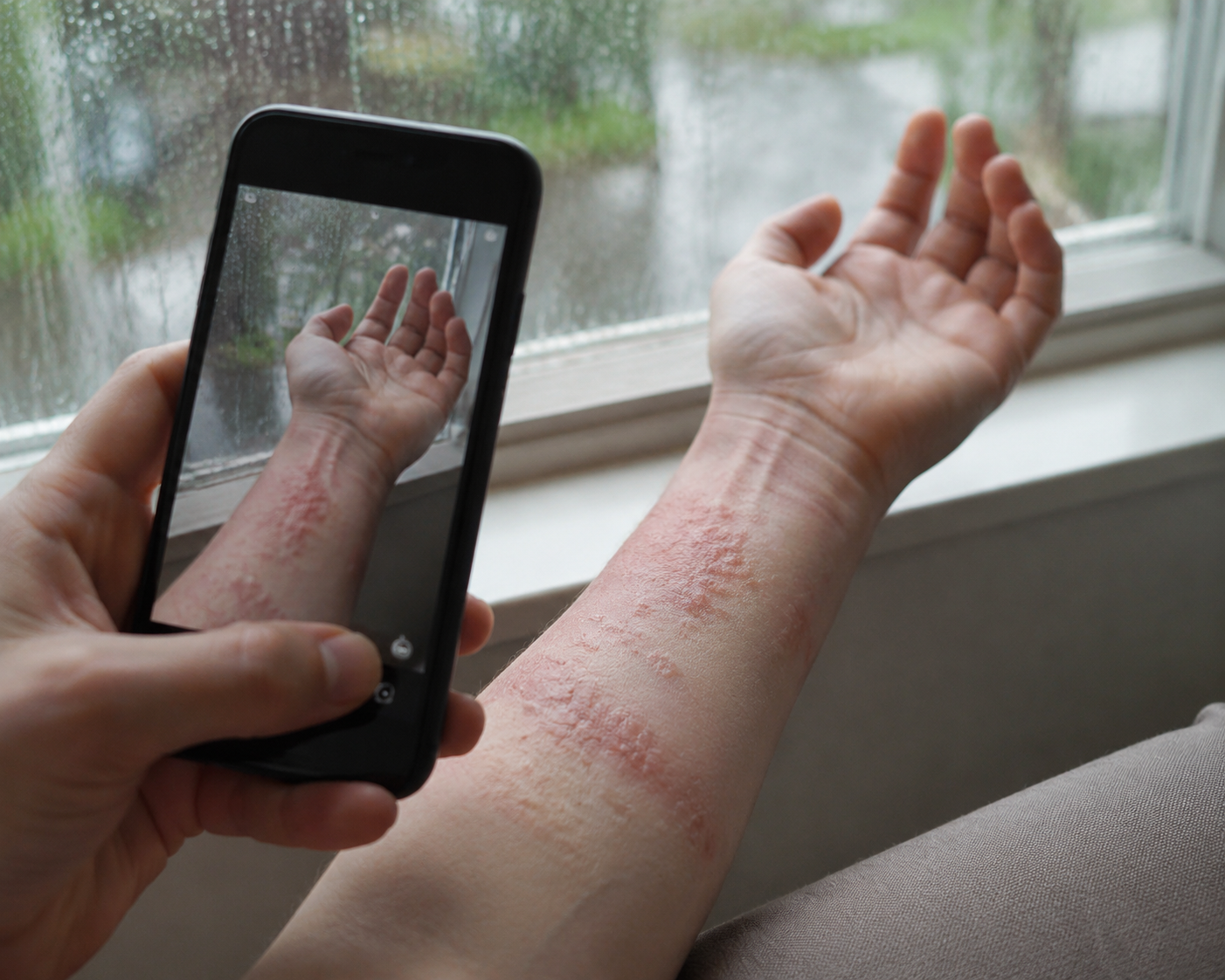 A forearm with eczema patches being photographed by smartphone near a rain-streaked window