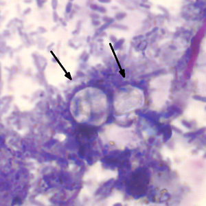Cyclospora cayetanensis oocysts under modified acid-fast stain with pink-to-red spherical oocysts on a blue-green background