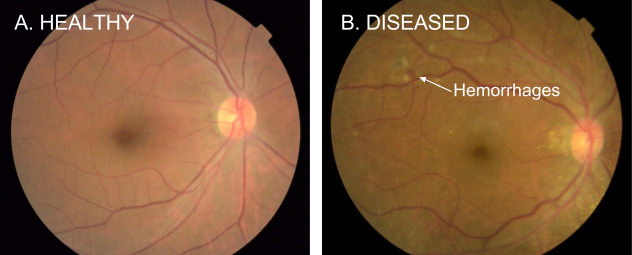 Retinal fundus image with AI-derived heatmap overlay from diabetic retinopathy analysis