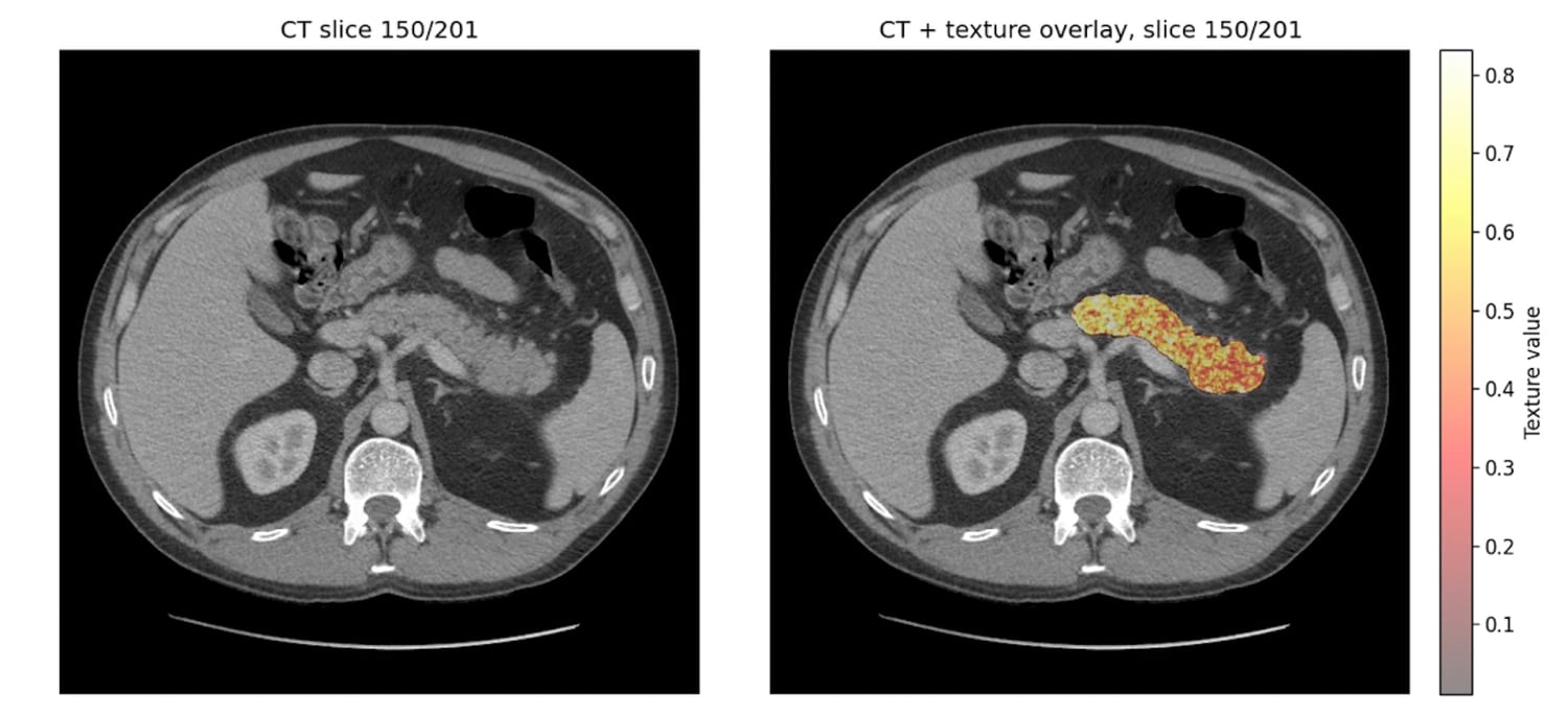 Axial CT scan with REDMOD AI overlay highlighting subtle pancreatic tissue changes