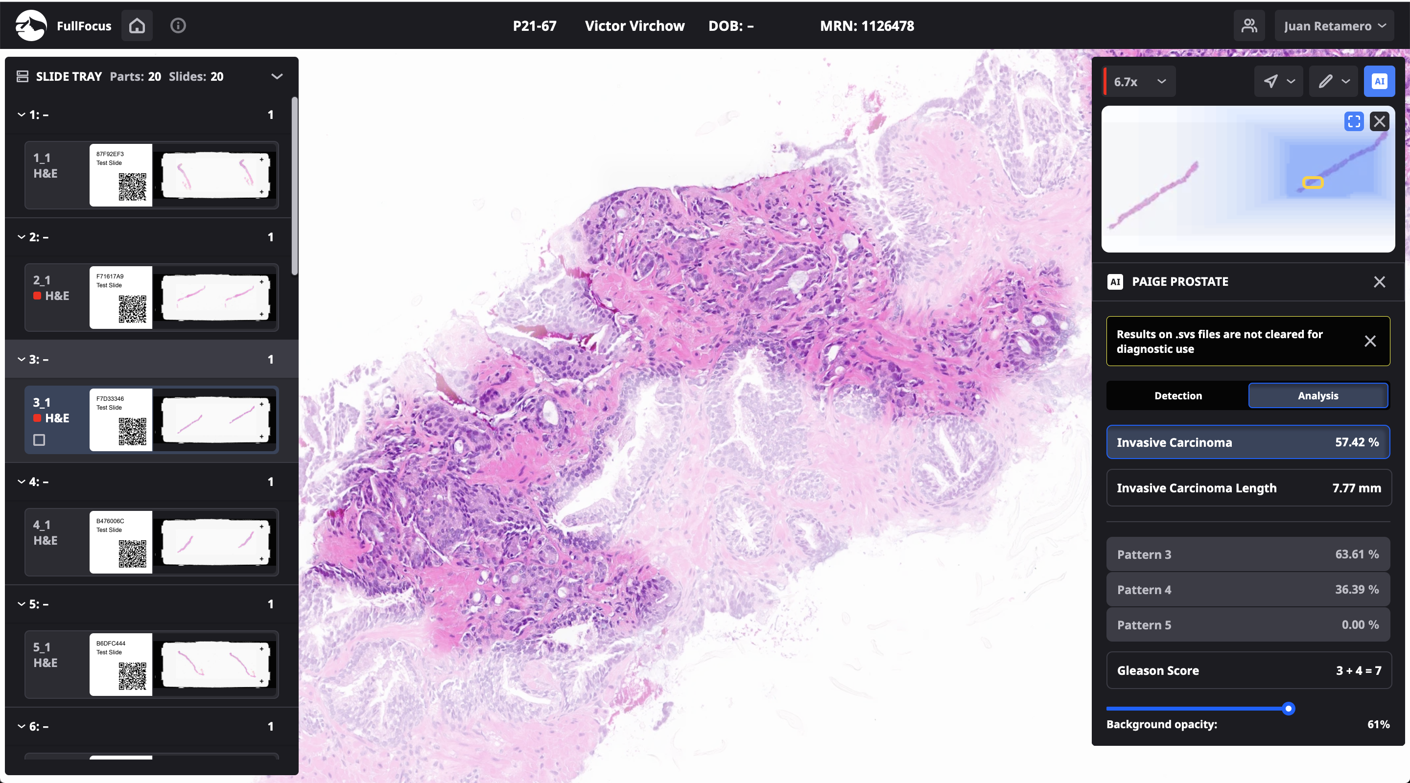 Screenshot of the Paige Prostate Grade and Quantify interface within the Sectra digital pathology viewer, showing AI-generated overlay regions on a prostate biopsy whole slide image alongside the slide overview panel.