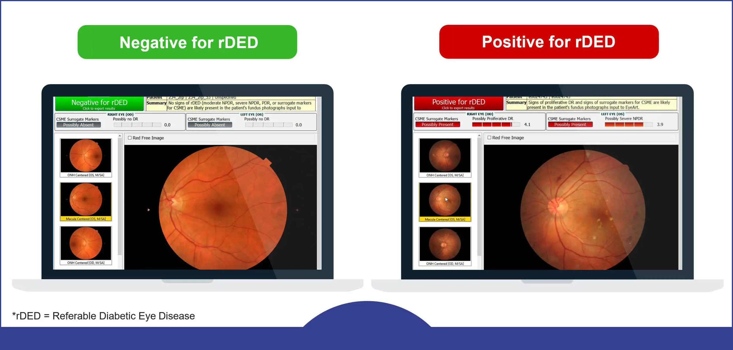 Clinical graphic showing EyeArt AI diabetic retinopathy screening accuracy metrics alongside low real-world adoption data