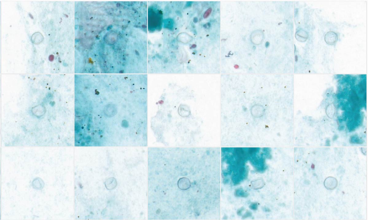 ARUP Laboratories AI-enhanced microscopy workstation used during the Cyclospora outbreak surge
