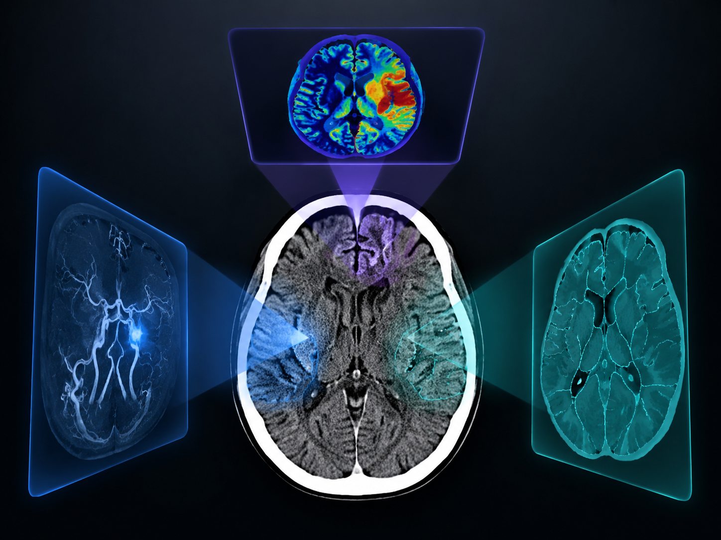Brain CT scan with three colored analytical overlays representing different AI stroke detection approaches